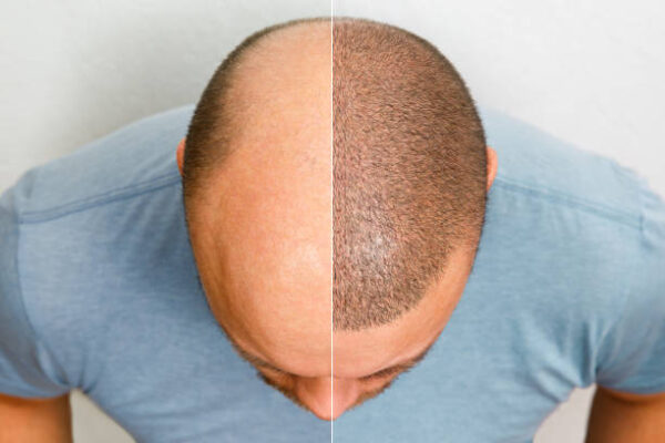 زراعة الشعر في دبي لقادة الأعمال: نتائج دقيقة لكنها مؤثرة Hair transplant in Dubai