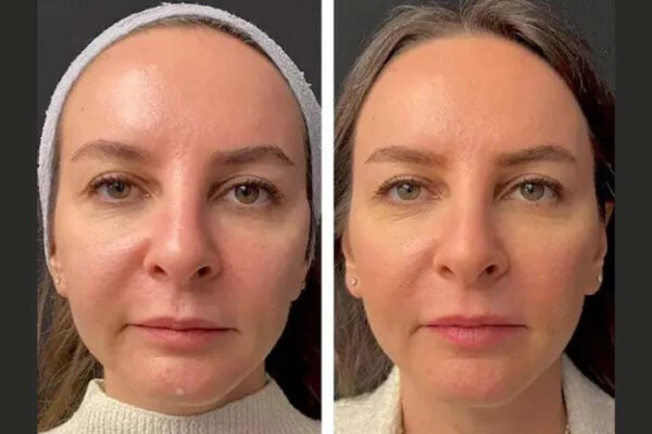Best Plastic Surgeons in Dubai: Why Natural Results Matter Mesotherapy in dubai
