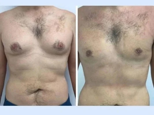 Why Athletes Choose the Best Gynecomastia Surgeons in Dubai gynecomastia-in-dubai